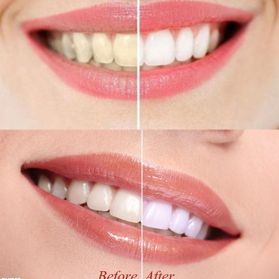 Dentes de carvão vegetal de ba - Teeth Whitening Ingredients avaliação e preço