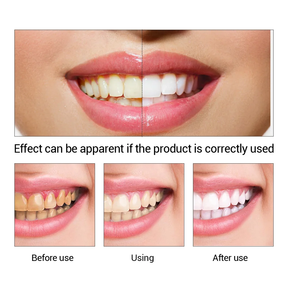 FTEENPLY Essência para claream - Teeth Whitening Remedies avaliação e preço