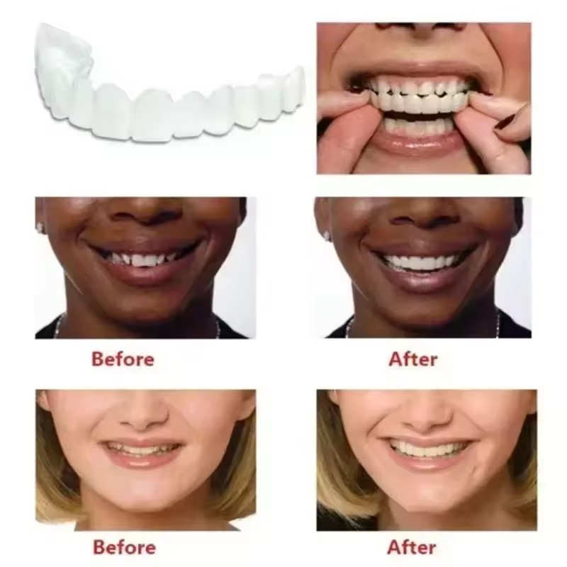 Veneers Dentários para Claream - Teeth Whitening For Braces avaliação e preço