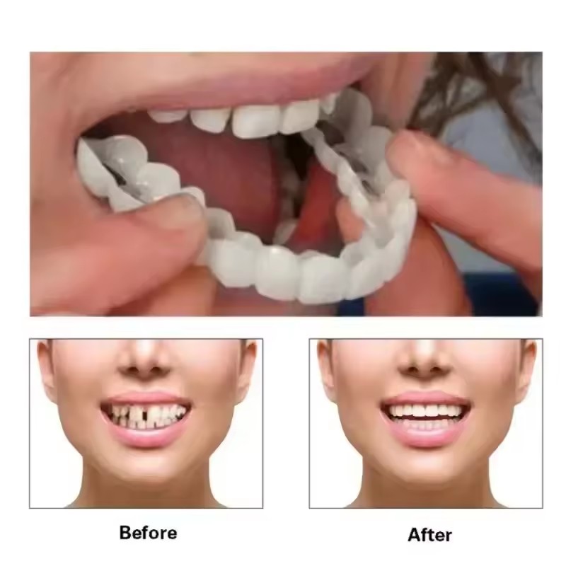 Veneers Dentários para Claream - Teeth Whitening For Braces avaliação e preço