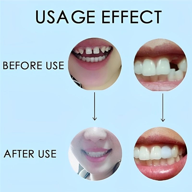[NOVO! ABMK】 2 Pares, Restaure - Teeth Whitening For Braces avaliação e preço