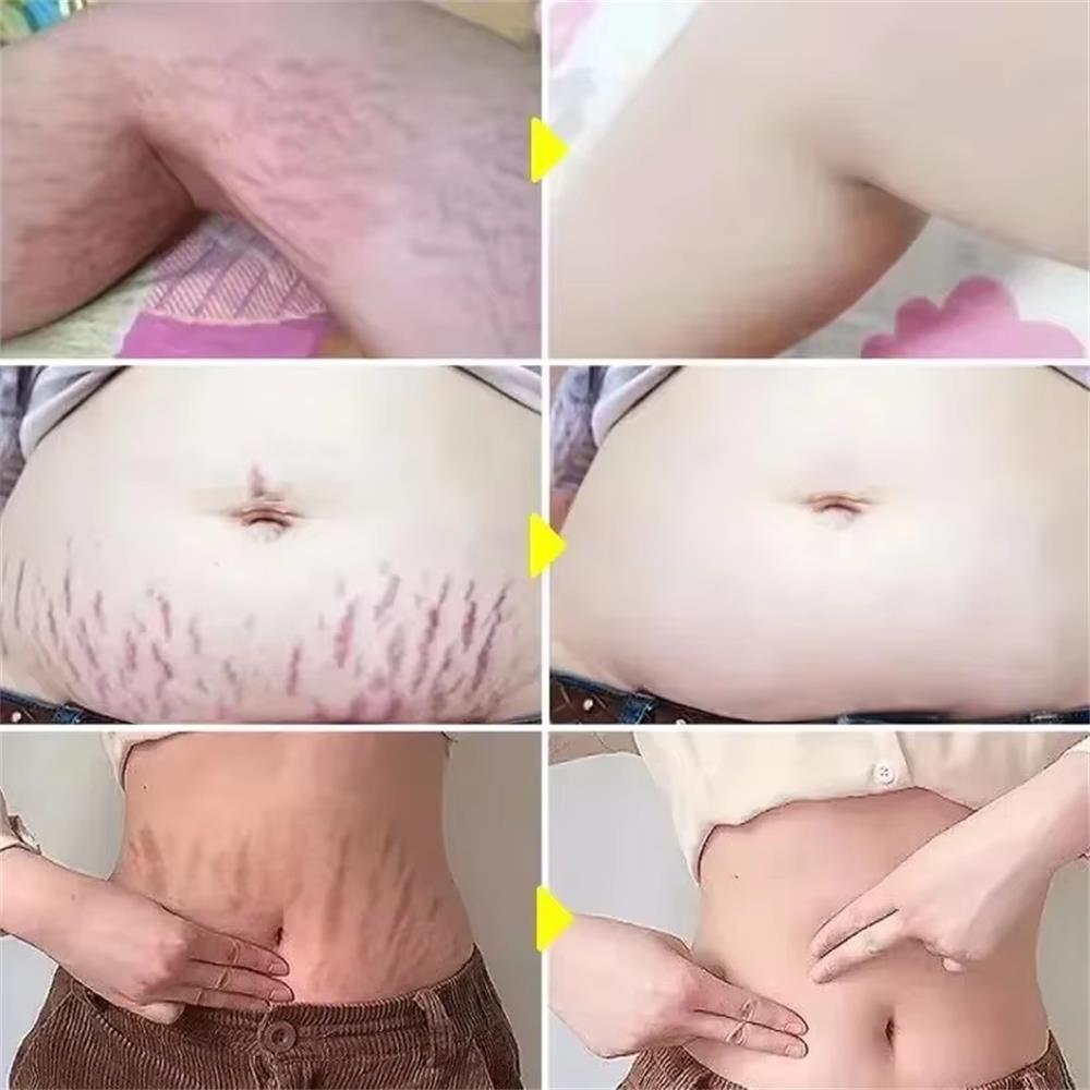 Creme para Remoção Permanente  - Teeth Whitening Pregnancy avaliação e preço